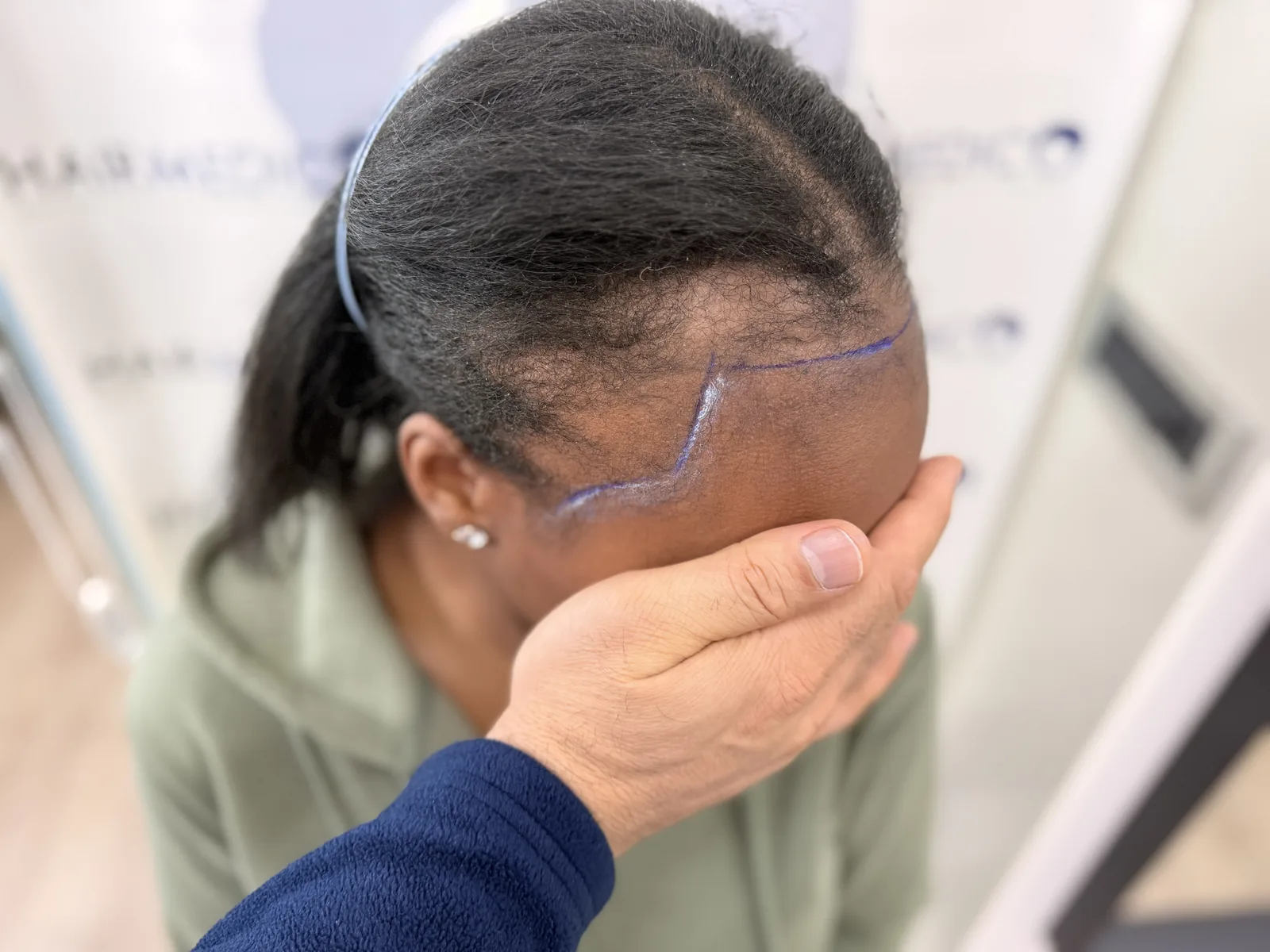 Donor line marked directly through a patient's own unshaven hair at Hairmedico Istanbul