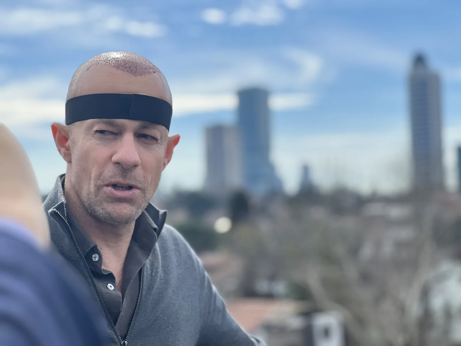 Hairmedico FUE patient shortly after surgery, showing the freshly transplanted hairline with the Istanbul skyline behind him
