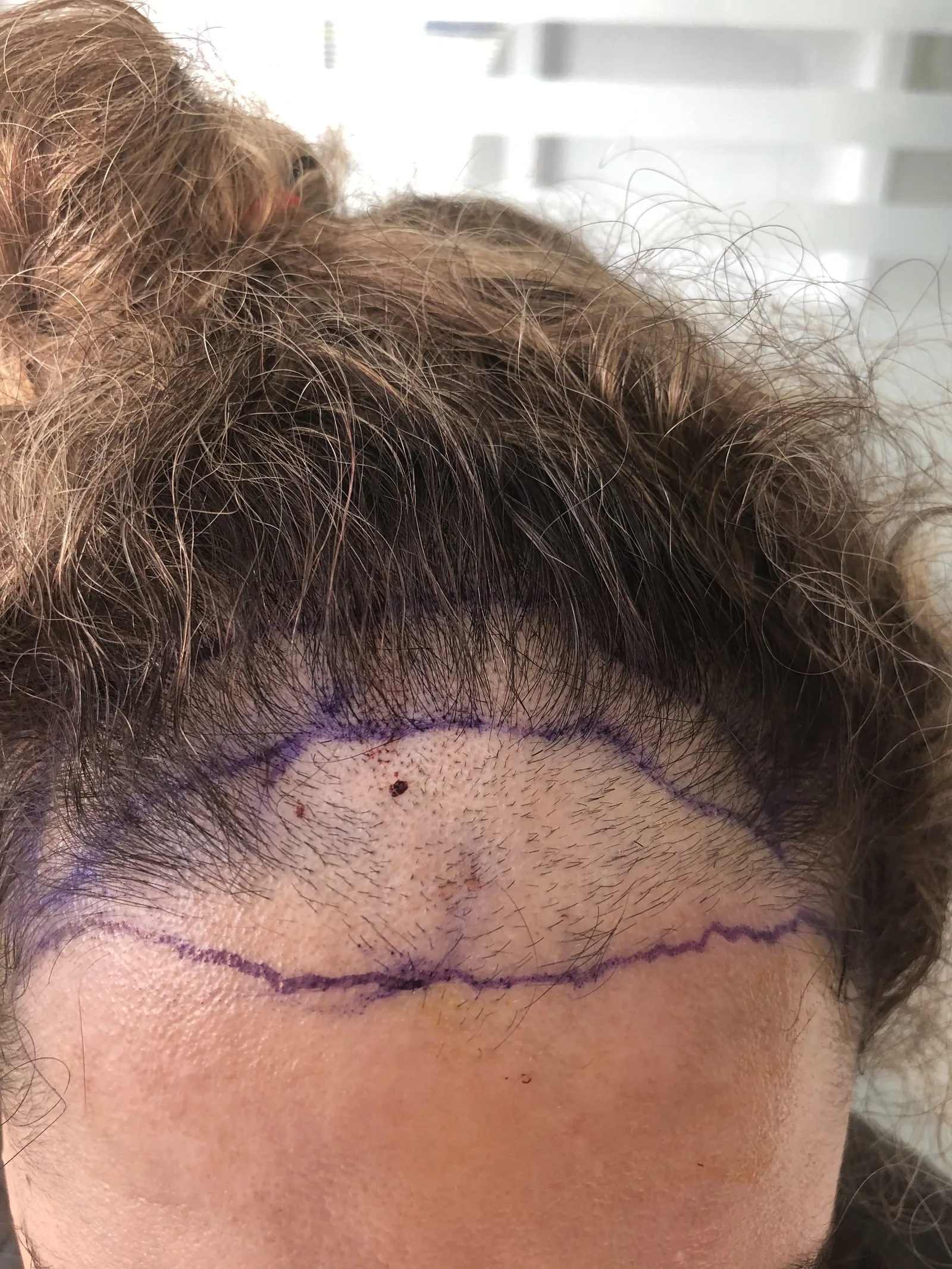 Close-up of a hairline and recipient area marked in surgical pen before a Hairmedico FUE hair transplant