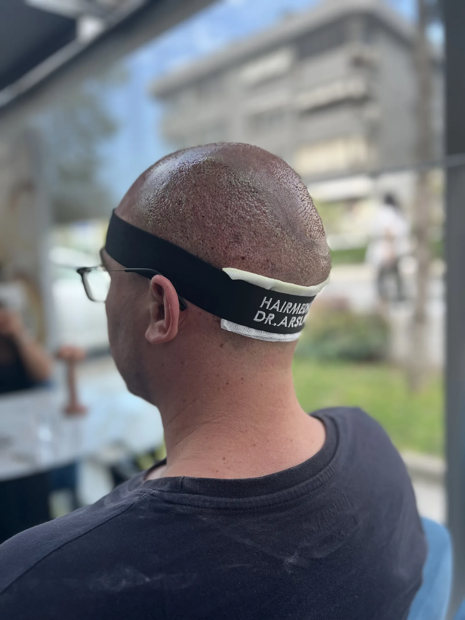 Close-up of a freshly transplanted recipient area on the day of surgery, wearing a Hairmedico Dr. Arslan headband