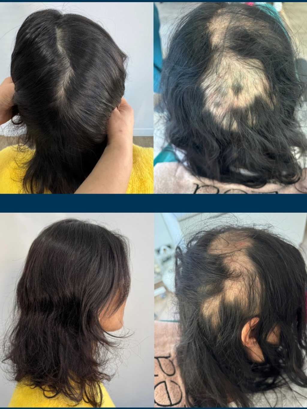Patientin mit Alopecia areata vor und nach einer PRP-Regenerationskur bei Hairmedico Istanbul