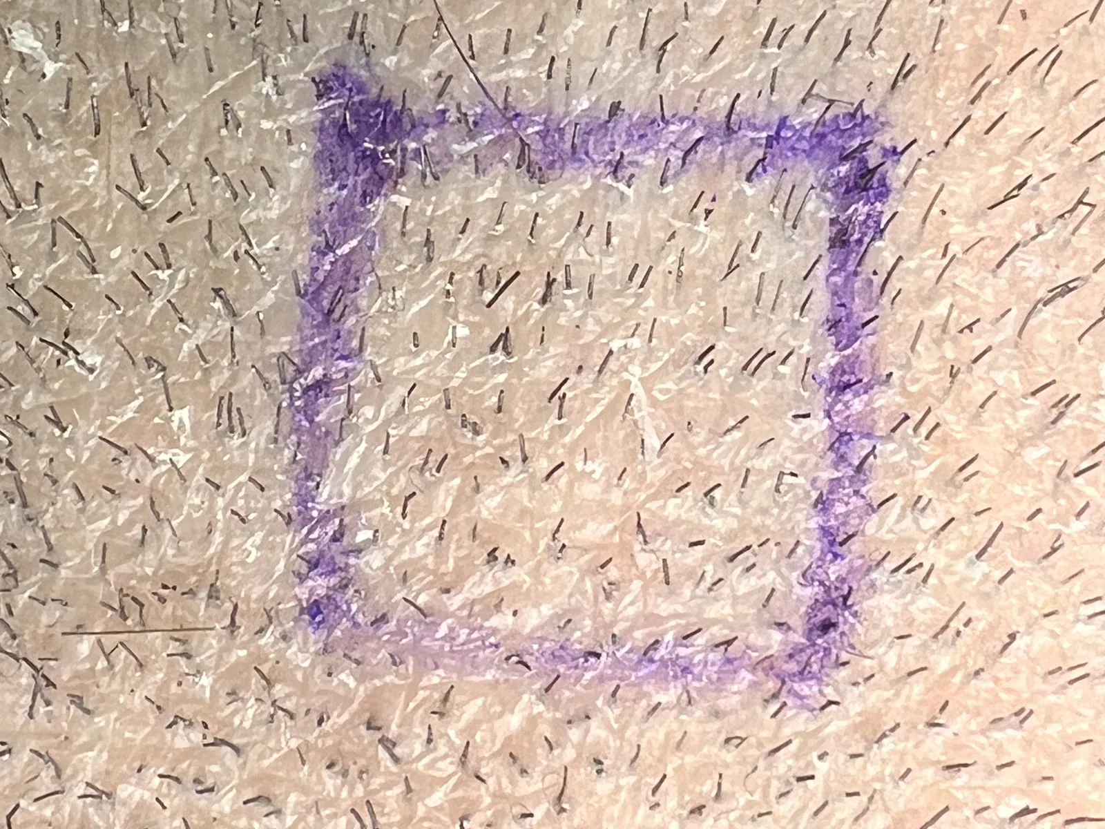 Close-up of a recipient area marked out in surgical pen ahead of channel opening