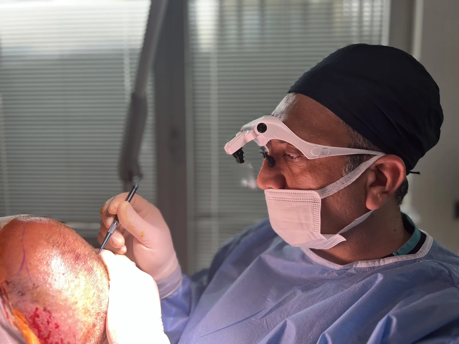 Hairmedico surgical team member performing precision graft extraction during a hair transplant procedure
