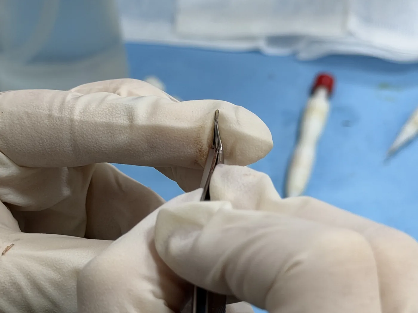 Macro close-up of a sapphire-tipped surgical blade used for hair transplant channel creation