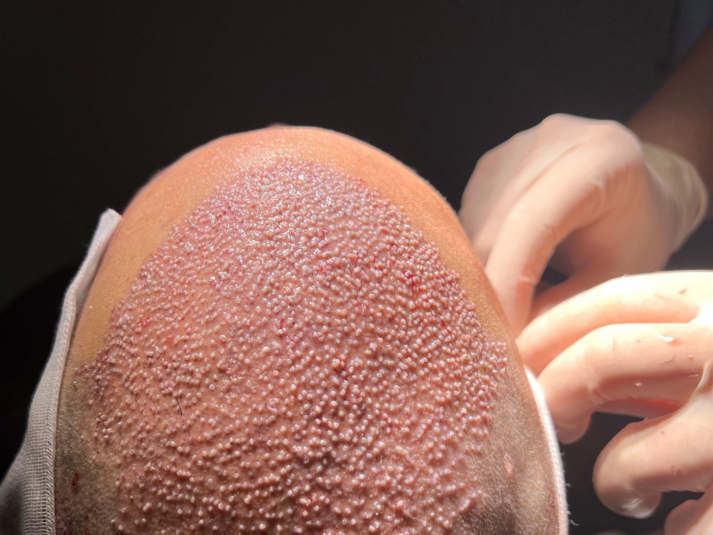 Live surgery demonstration during Hairmedico Academy training