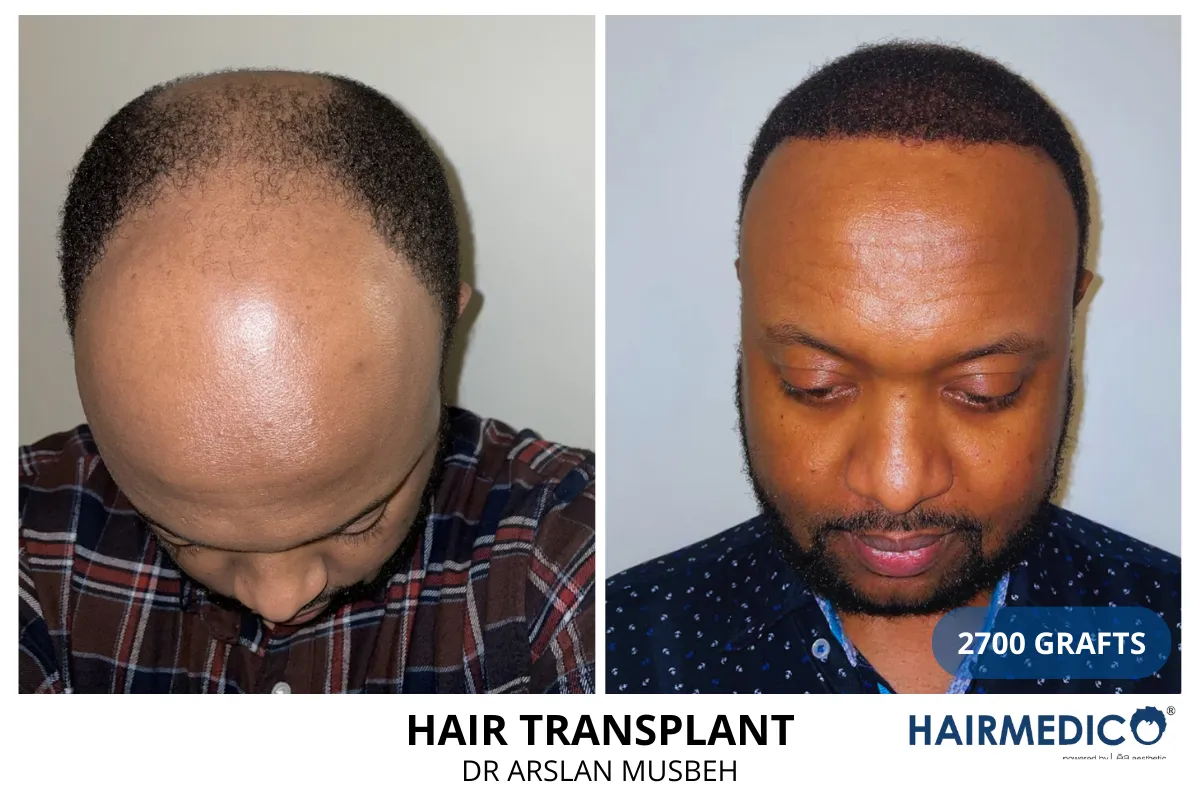 Afro hair transplant before and after result — 2,700 grafts, Dr. Arslan Musbeh, Hairmedico Istanbul