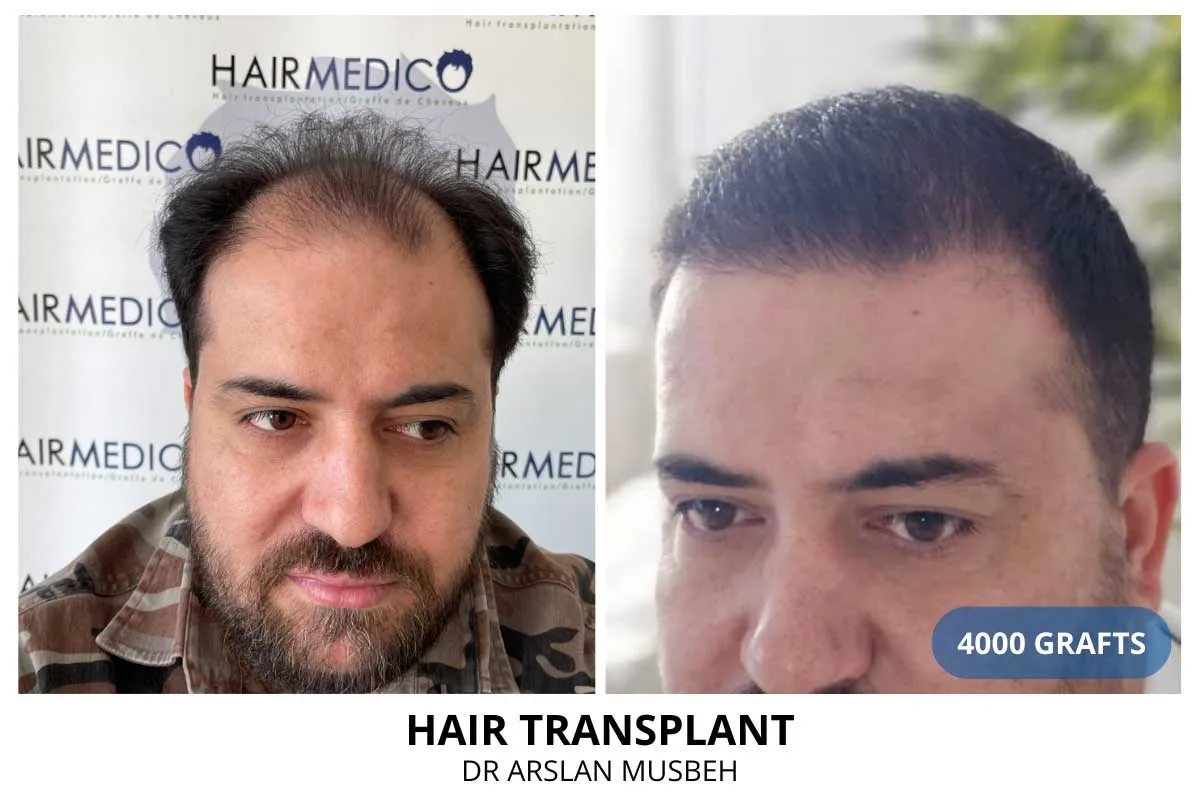 Hair transplant before and after result — 4,000 grafts, Dr. Arslan Musbeh, Hairmedico Istanbul