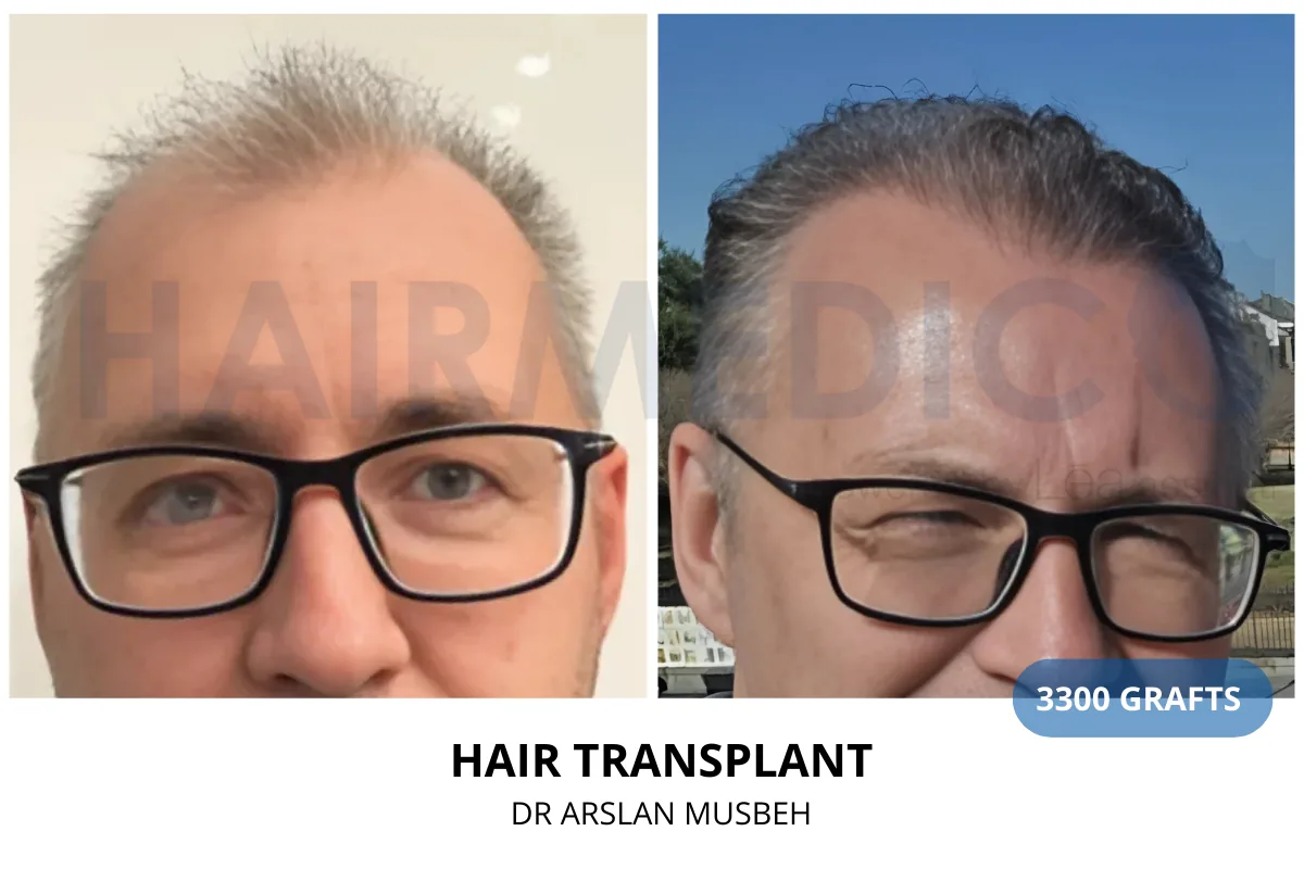 Hair transplant before and after result — 3,300 grafts, Dr. Arslan Musbeh, Hairmedico Istanbul