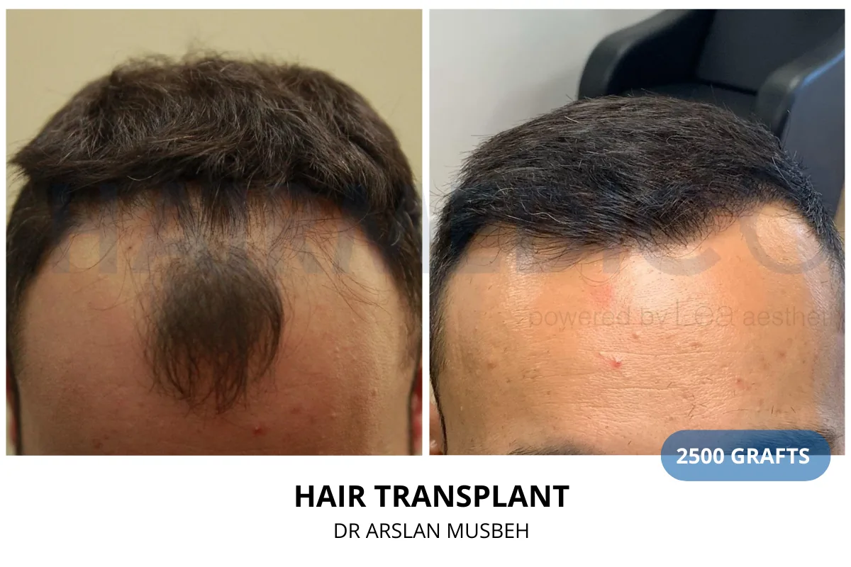 Hair transplant before and after result — 2,500 grafts, Dr. Arslan Musbeh, Hairmedico Istanbul
