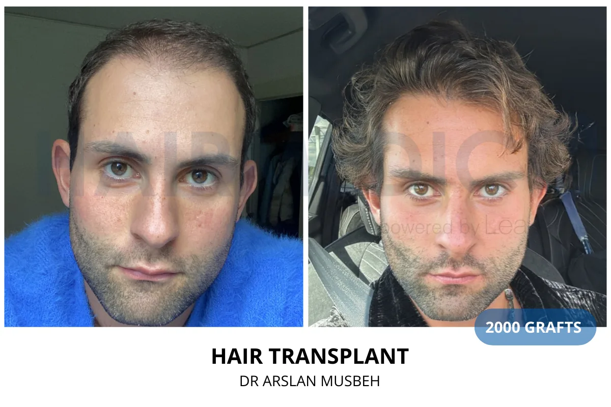 Hair transplant before and after result — 2,000 grafts, Dr. Arslan Musbeh, Hairmedico Istanbul