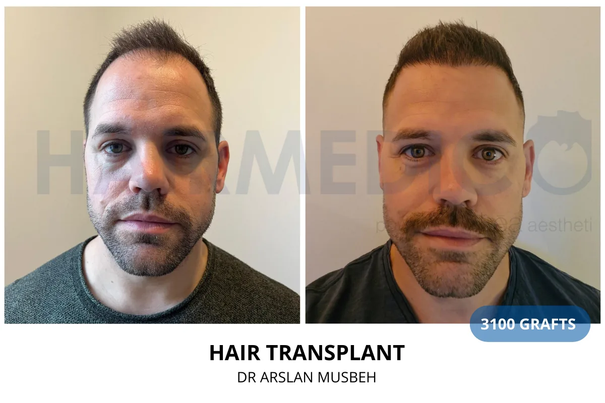 Hair transplant before and after result — 3,100 grafts, Dr. Arslan Musbeh, Hairmedico Istanbul