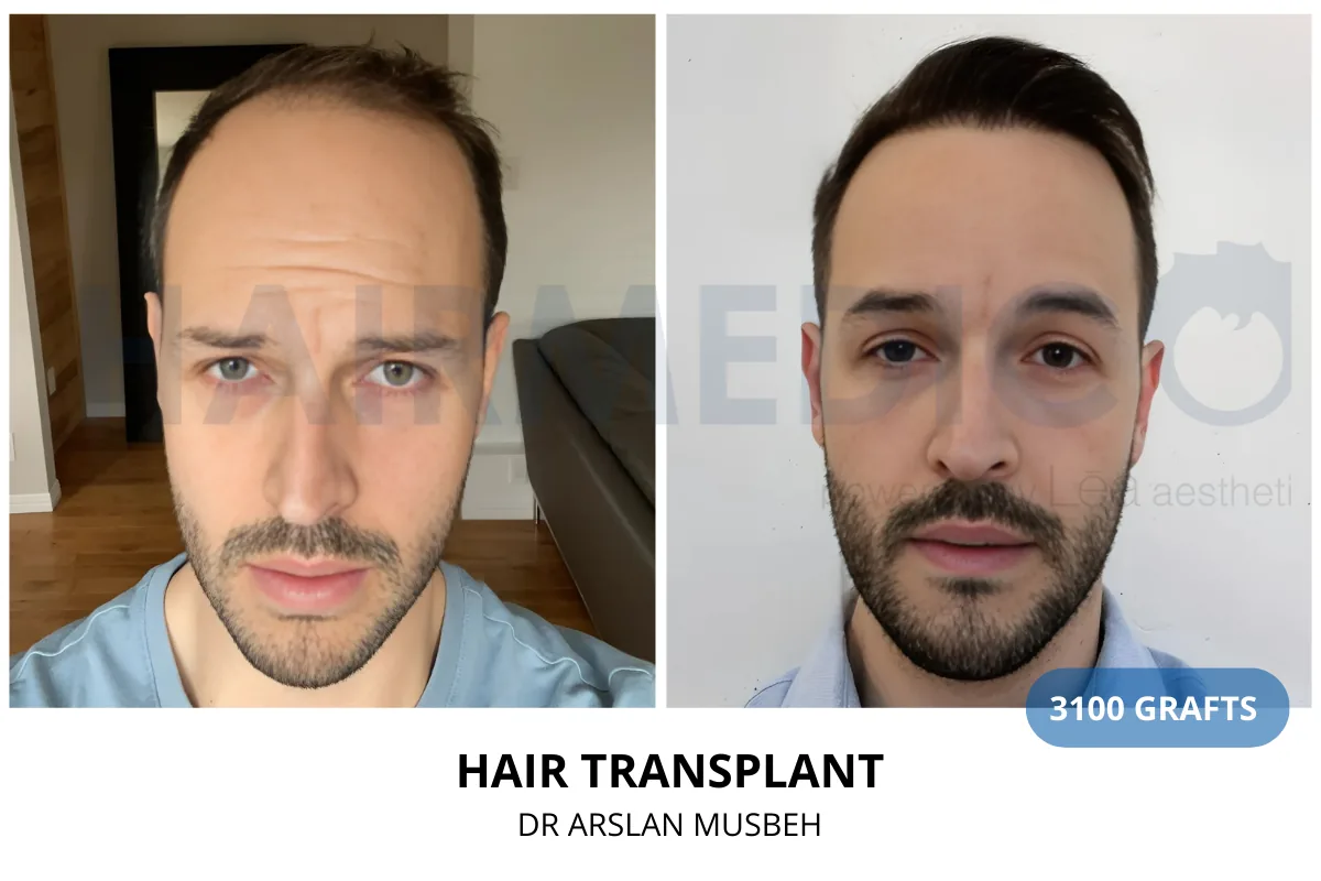 Hair transplant before and after result — 3,100 grafts, Dr. Arslan Musbeh, Hairmedico Istanbul