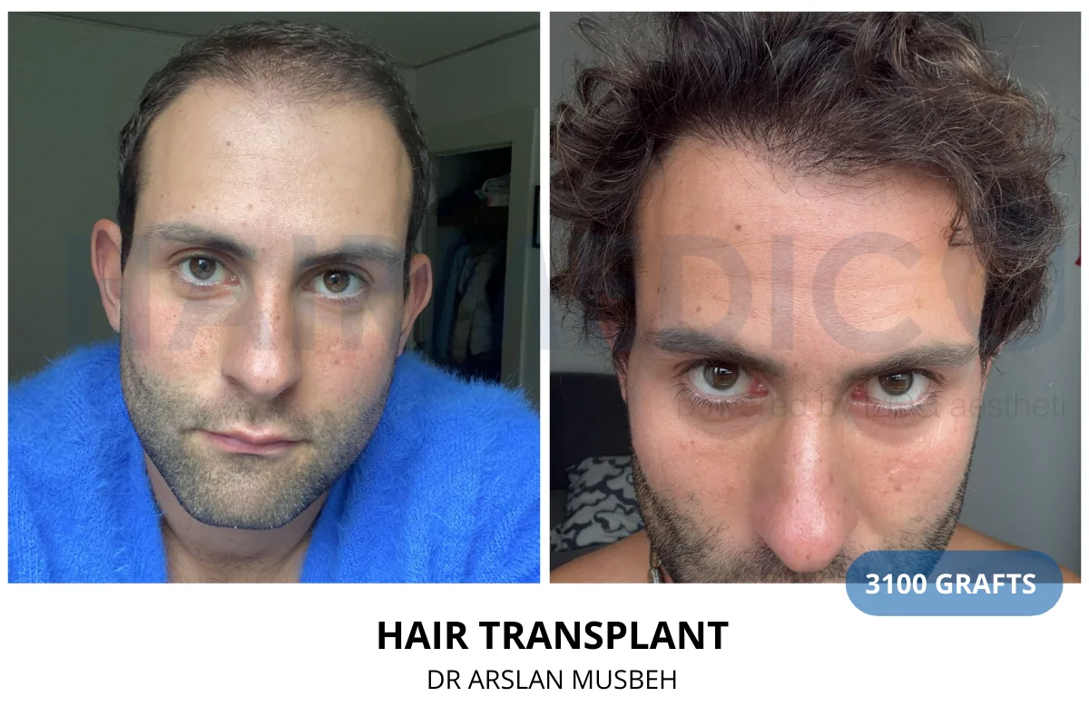 Hair transplant before and after result — 3,100 grafts, Dr. Arslan Musbeh, Hairmedico Istanbul