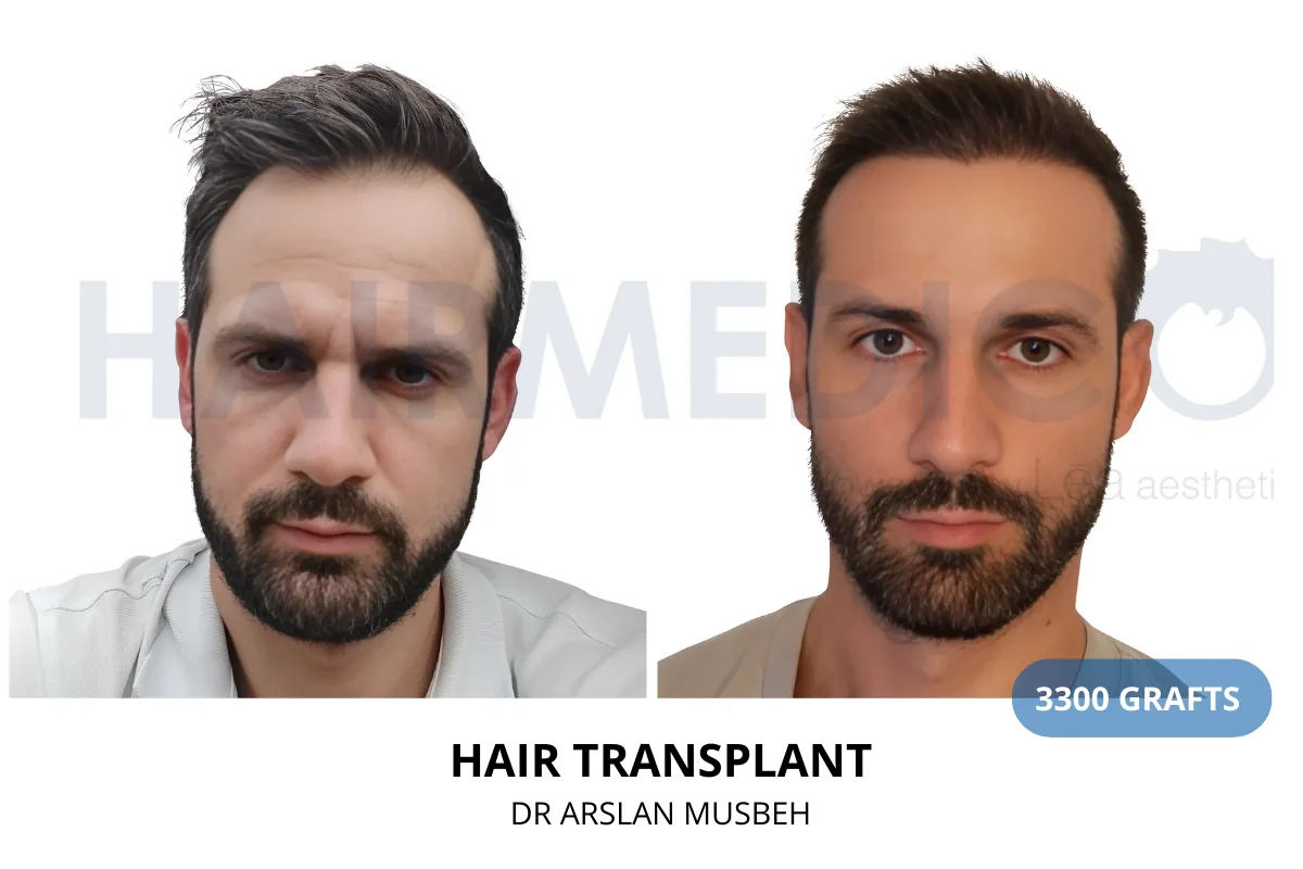 Hair transplant before and after result — 3,300 grafts, Dr. Arslan Musbeh, Hairmedico Istanbul