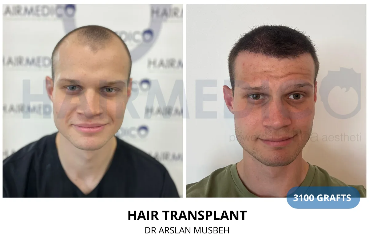 Hair transplant before and after result — 3,100 grafts, Dr. Arslan Musbeh, Hairmedico Istanbul