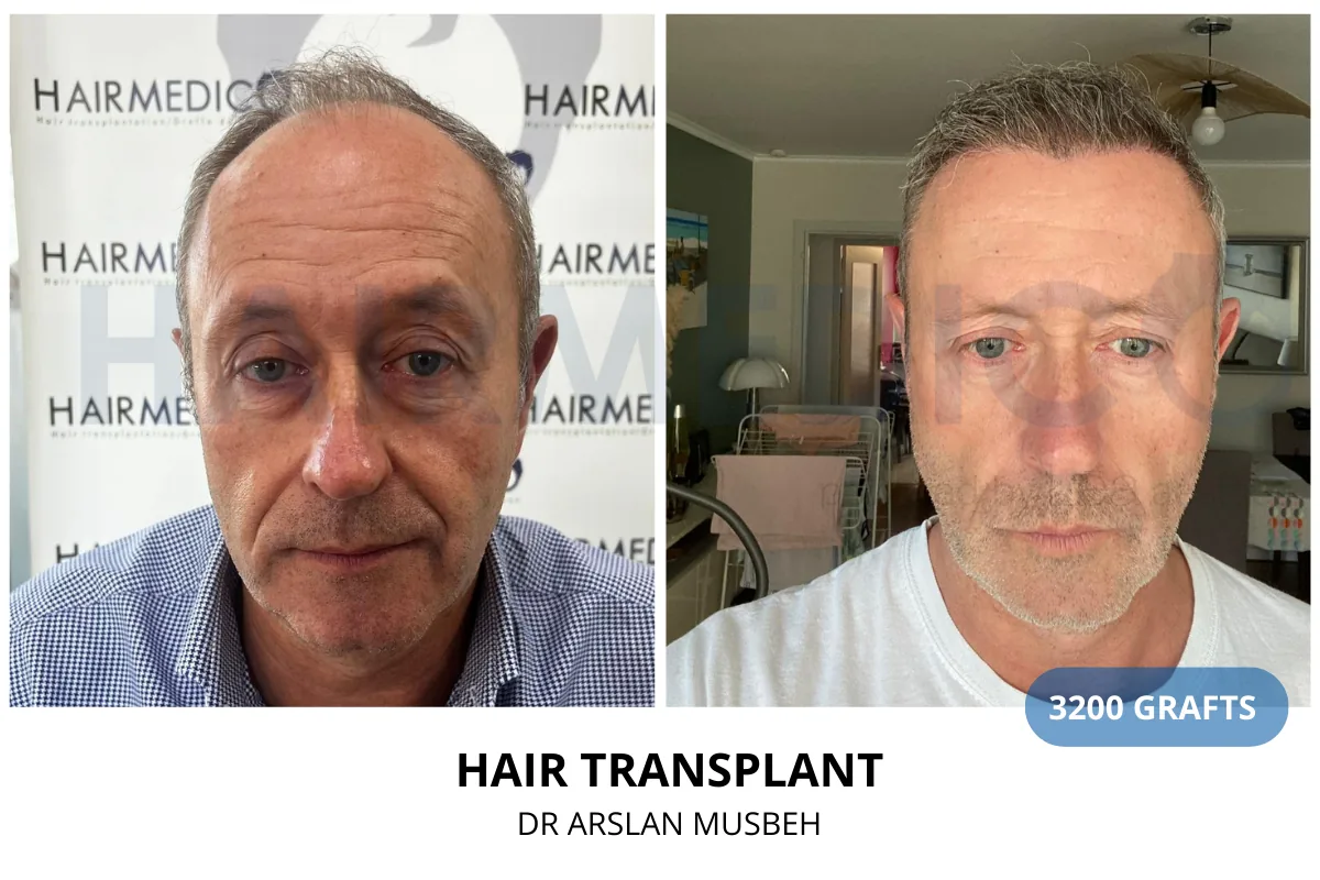 Hair transplant before and after result — 3,200 grafts, Dr. Arslan Musbeh, Hairmedico Istanbul
