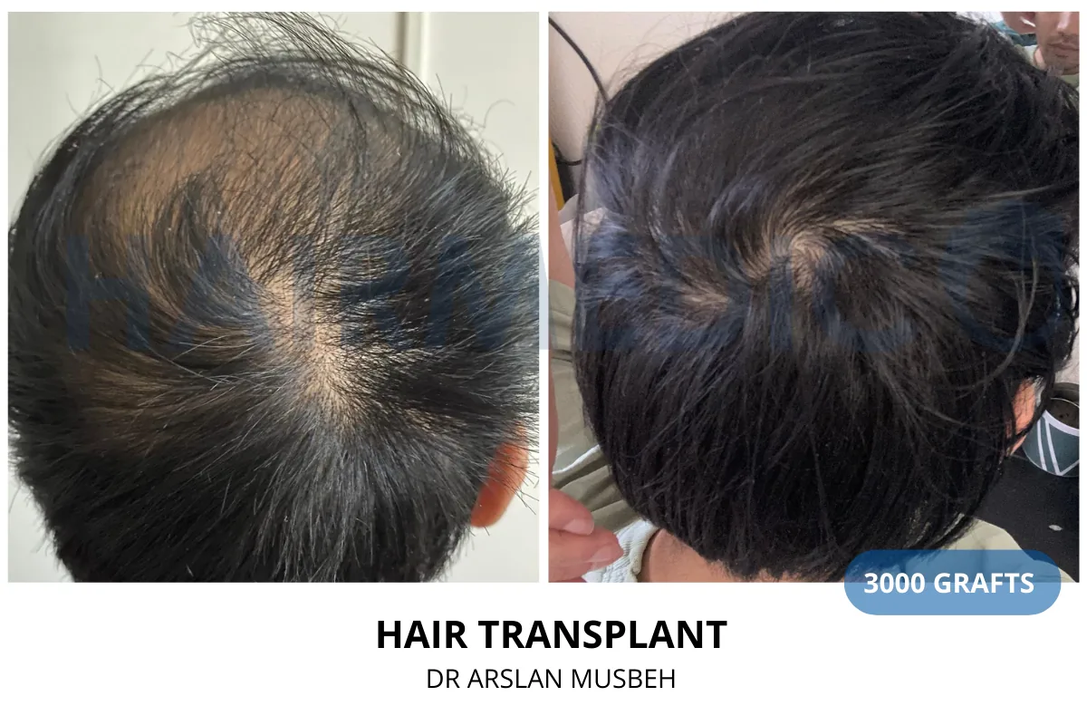 Hair transplant before and after result — 3,000 grafts, Dr. Arslan Musbeh, Hairmedico Istanbul