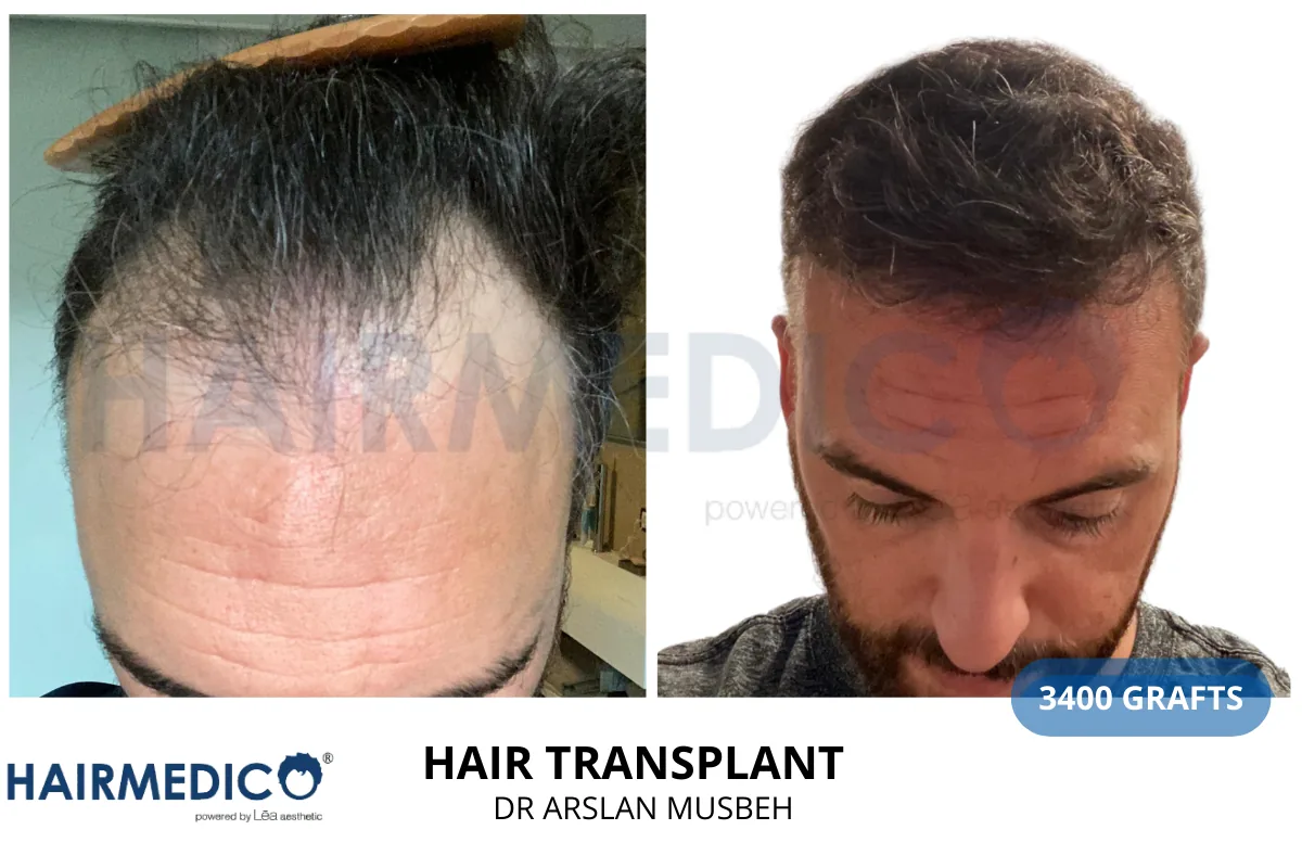 Hair transplant before and after result — 3,400 grafts, Dr. Arslan Musbeh, Hairmedico Istanbul