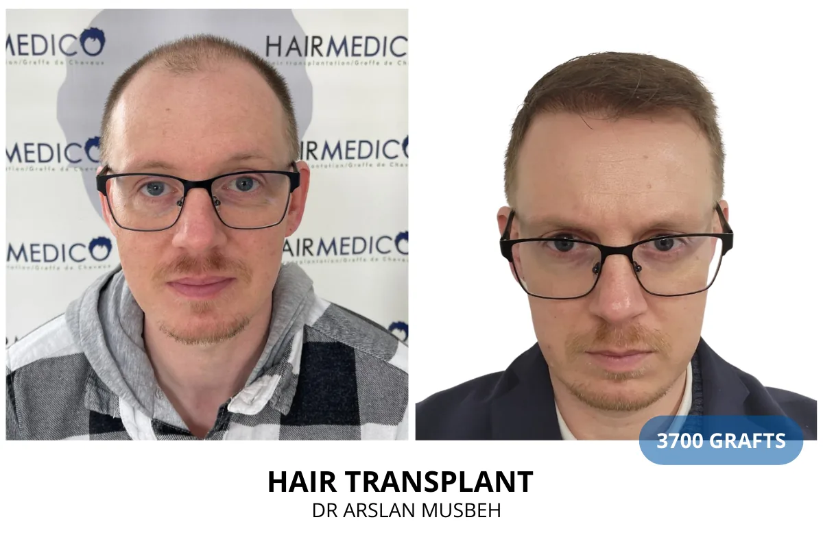 Hair transplant before and after result — 3,700 grafts, Dr. Arslan Musbeh, Hairmedico Istanbul