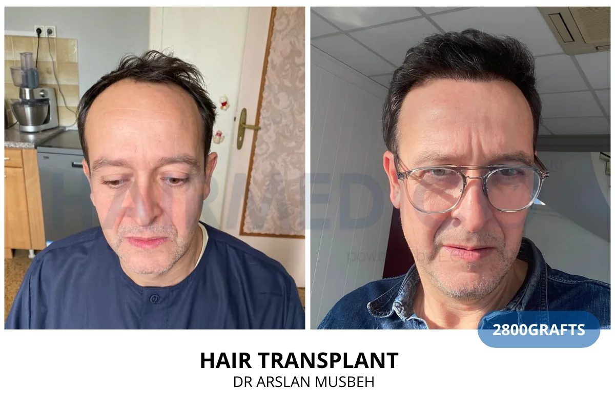 Hair transplant before and after result — 2,800 grafts, Dr. Arslan Musbeh, Hairmedico Istanbul