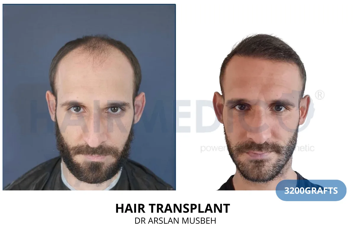 Hair transplant before and after result — 3,200 grafts, Dr. Arslan Musbeh, Hairmedico Istanbul