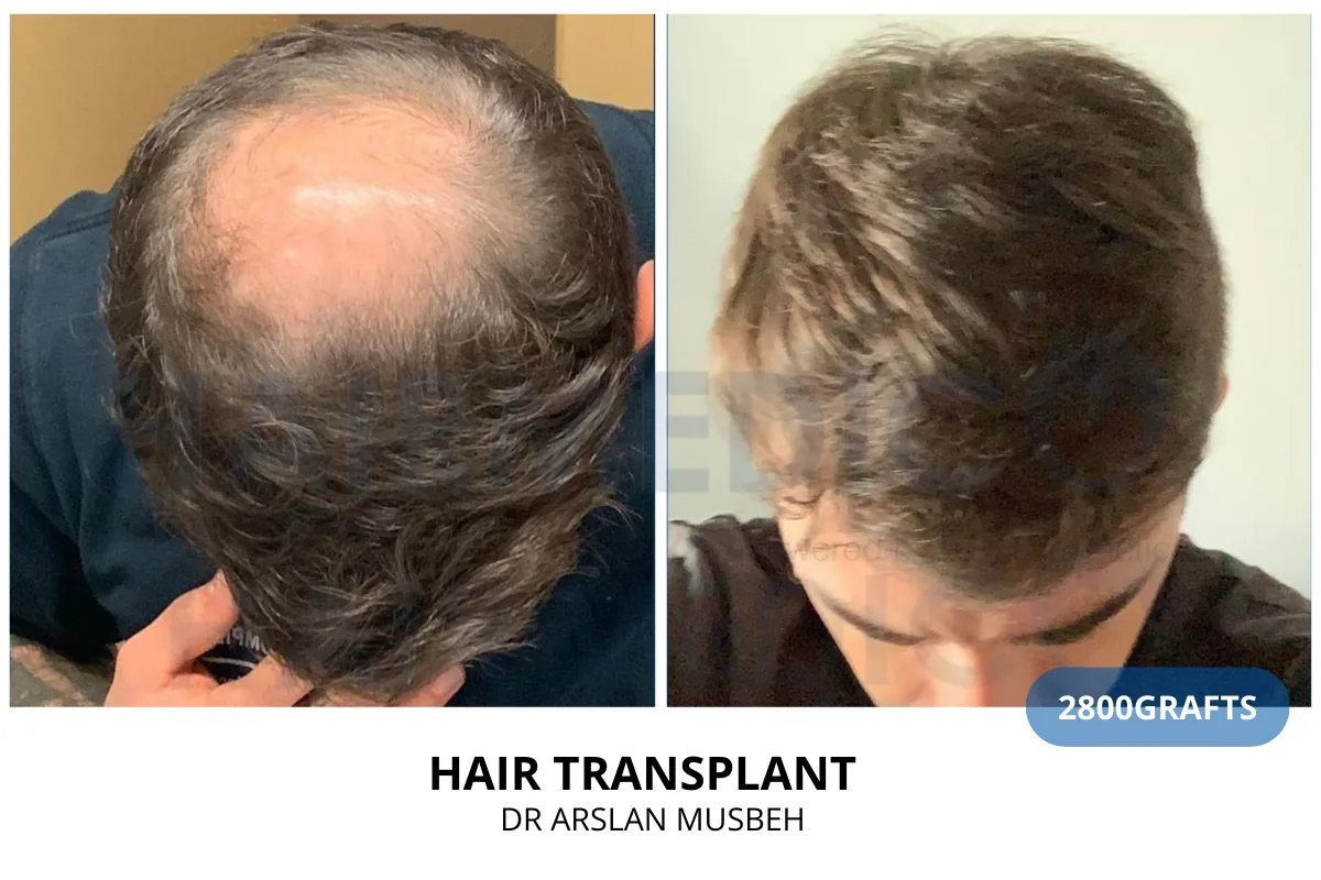 Hair transplant before and after result — 2,800 grafts, Dr. Arslan Musbeh, Hairmedico Istanbul