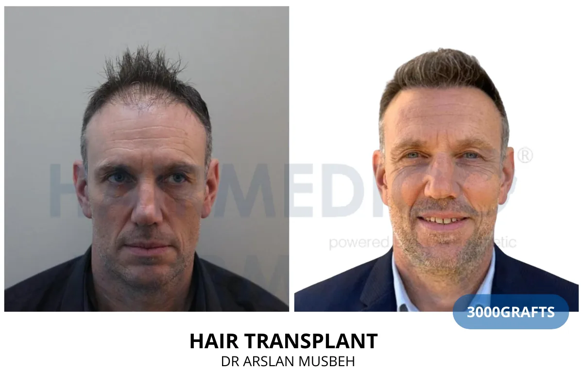 Hair transplant before and after result — 3,000 grafts, Dr. Arslan Musbeh, Hairmedico Istanbul