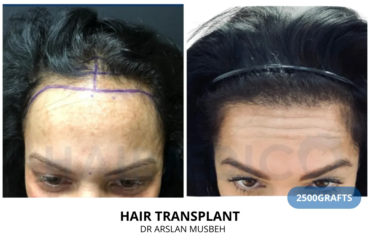 Women hair transplant before and after result — 2,500 grafts, Dr. Arslan Musbeh, Hairmedico Istanbul