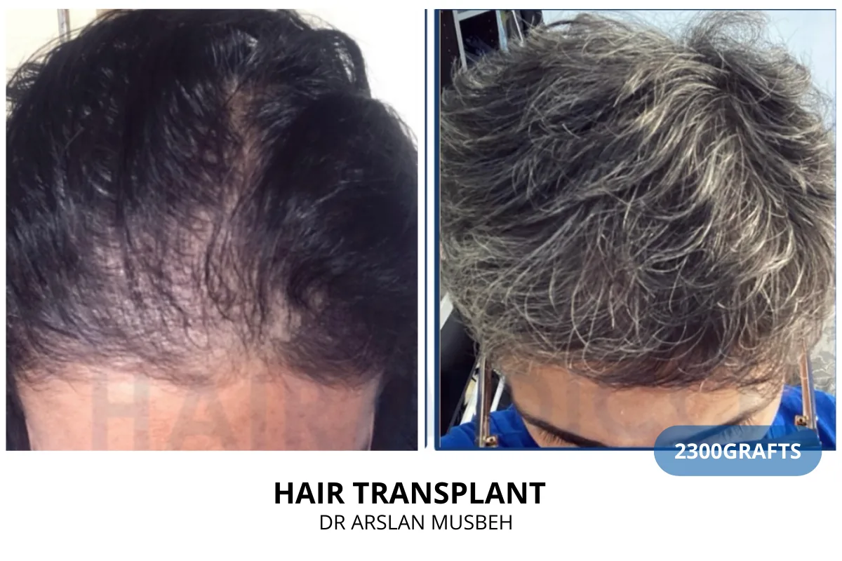 Hair transplant before and after result — 2,300 grafts, Dr. Arslan Musbeh, Hairmedico Istanbul