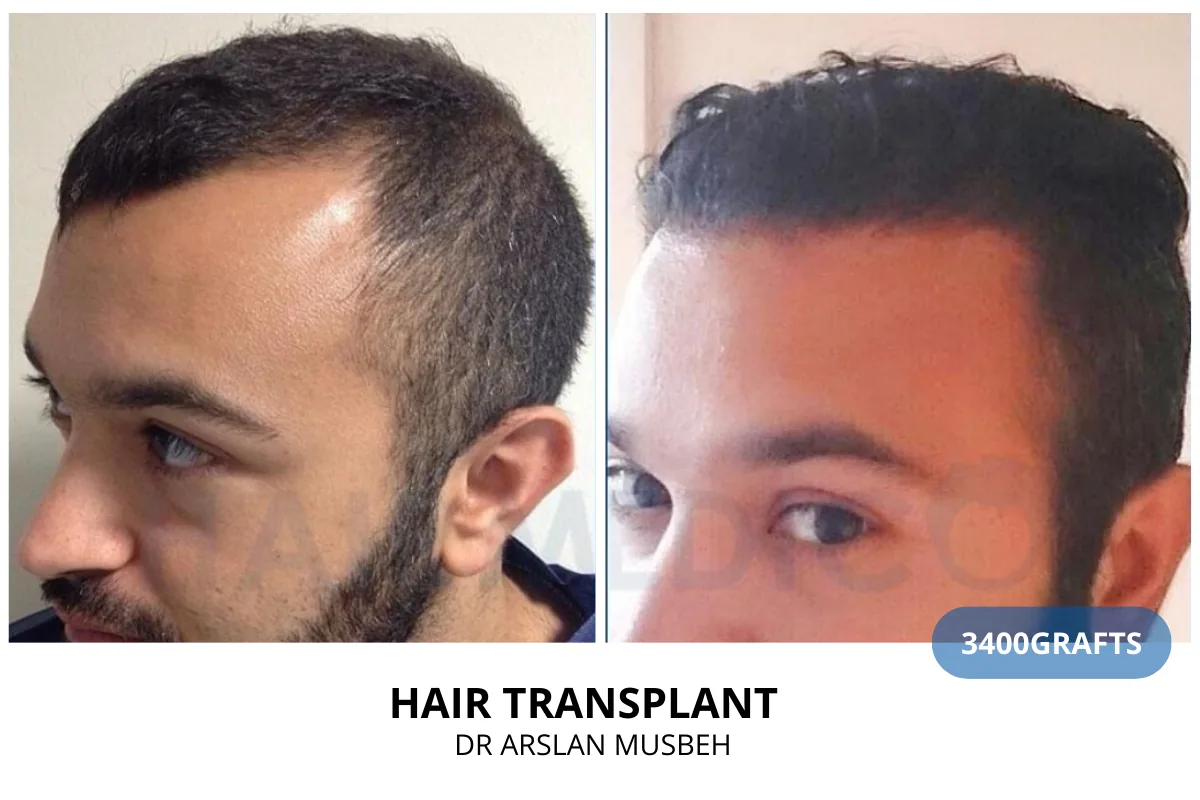 Hair transplant before and after result — 3,400 grafts, Dr. Arslan Musbeh, Hairmedico Istanbul
