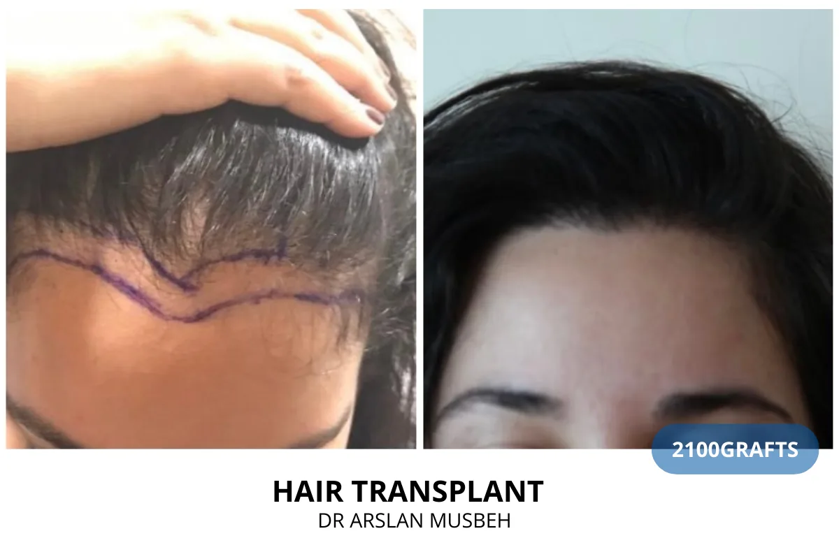 Women hair transplant before and after result — 2,100 grafts, Dr. Arslan Musbeh, Hairmedico Istanbul