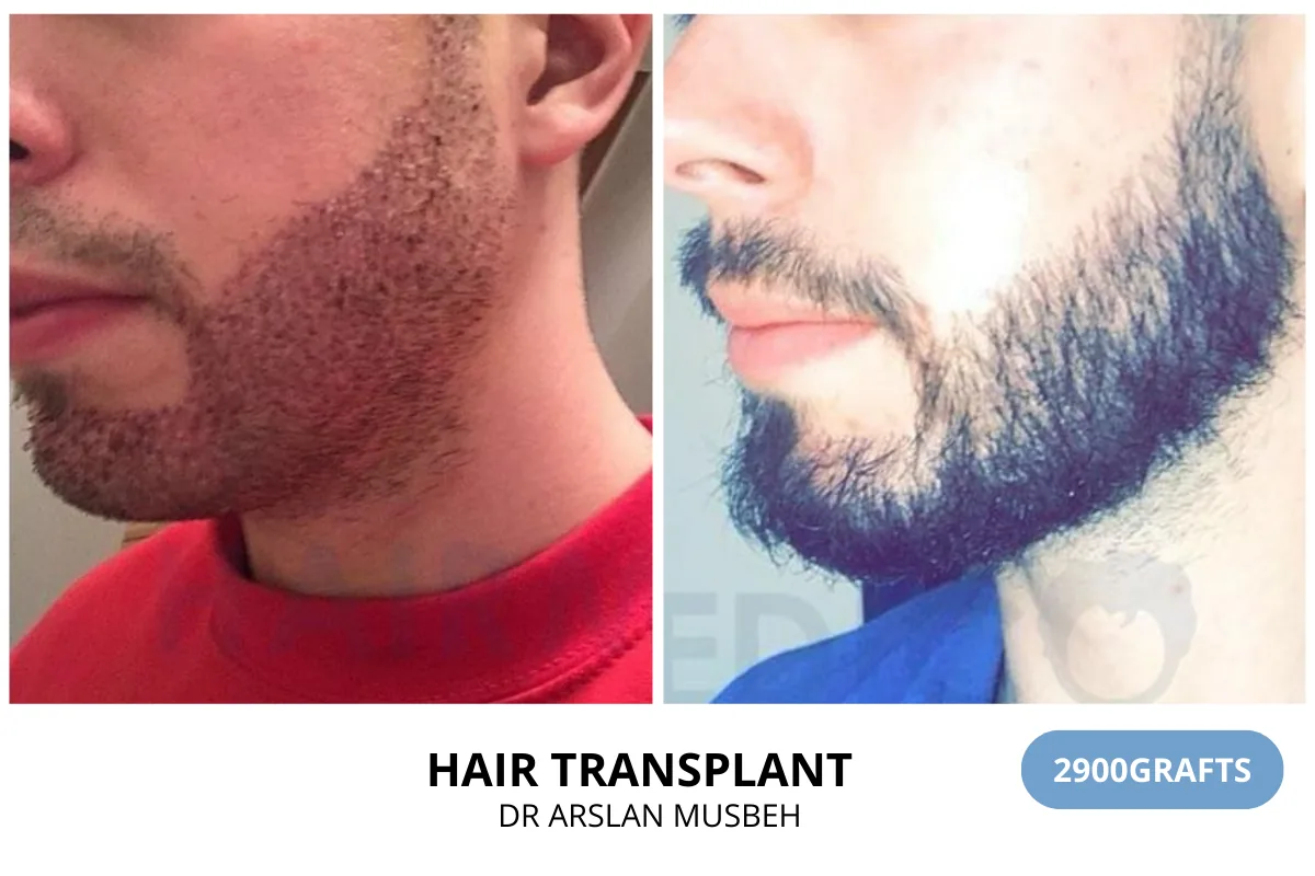 Hair transplant before and after result — 2,900 grafts, Dr. Arslan Musbeh, Hairmedico Istanbul