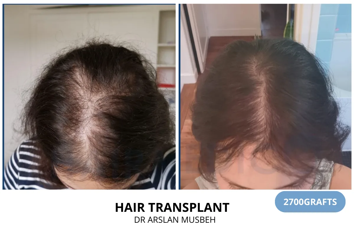 Women hair transplant before and after result — 2,700 grafts, Dr. Arslan Musbeh, Hairmedico Istanbul