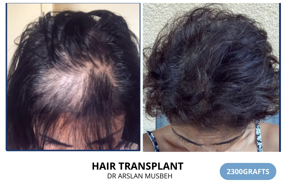 Women hair transplant before and after result — 2,300 grafts, Dr. Arslan Musbeh, Hairmedico Istanbul