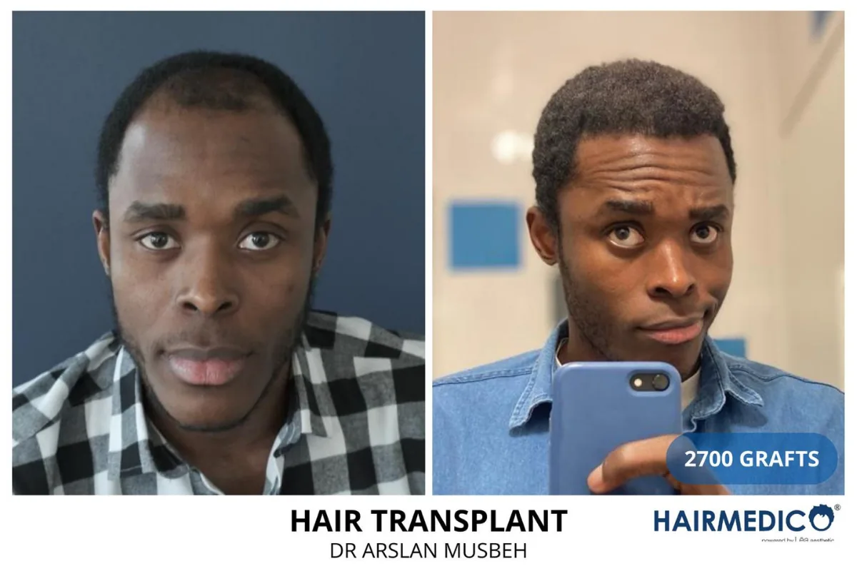 Afro hair transplant before and after result — 2,700 grafts, Dr. Arslan Musbeh, Hairmedico Istanbul